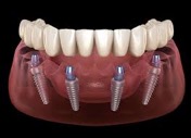 All On Four dental implants Bayside Family Dentistry