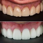 Before and After photograph of Dental Crowns